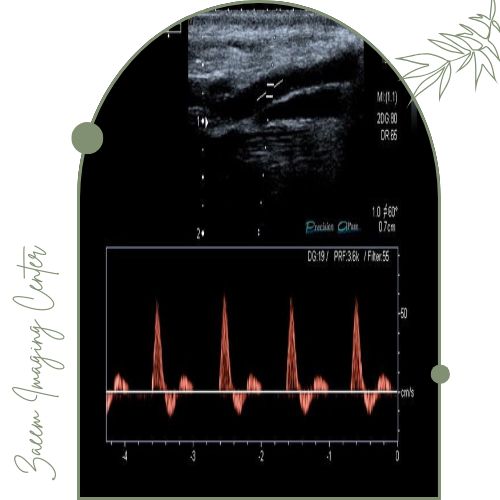 سونوگرافی داپلر برای واریس پا