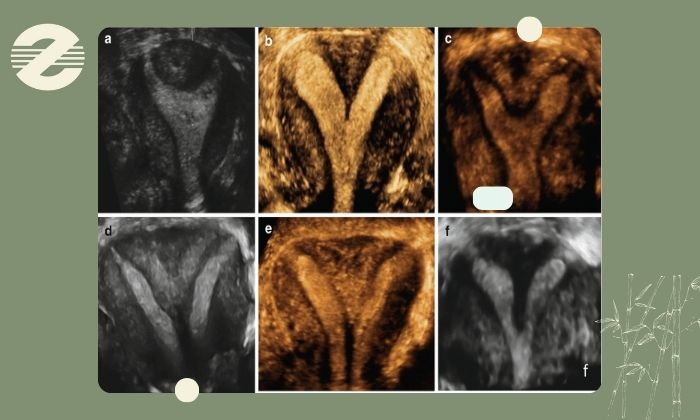 سونوگرافی سه ‌بعدی آنومالی ‌های رحم چیست؟