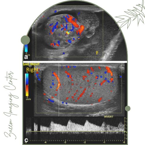 سونوگرافی کالر داپلر بیضه چیست؟