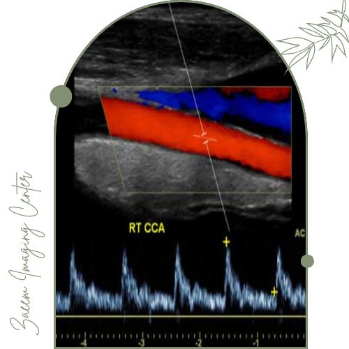 سونوگرافی کالر داپلر کاروتید چیست؟