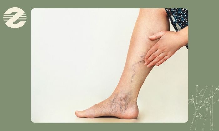 علائم شایع واریس پا علائم شایع واریس پا