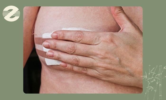 مراقبت ‌های پس از نمونه ‌برداری پستان