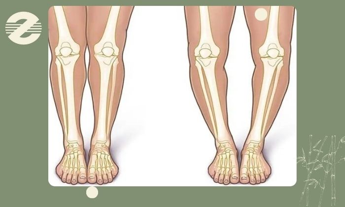 موارد کاربرد رادیوگرافی الایمنت ویو