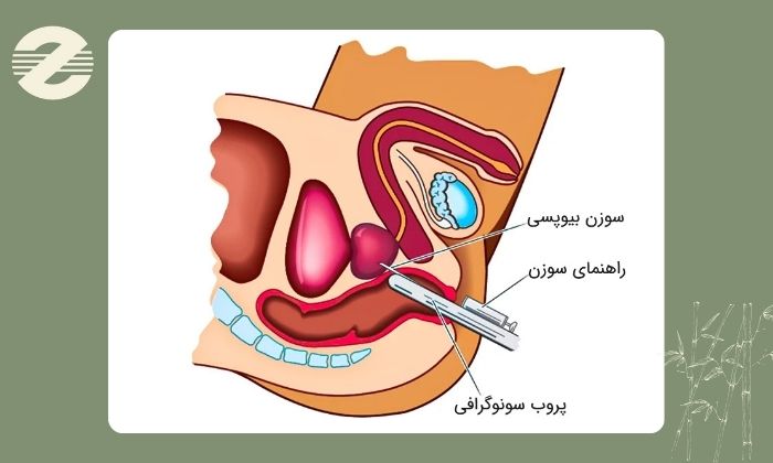 نمونه ‌برداری پروستات چگونه انجام می ‌شود؟
