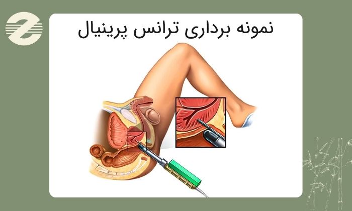 نمونه ‌برداری پروستات چگونه انجام می ‌شود؟