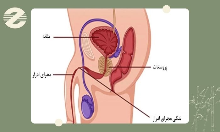 چرا رتروگرید یورتروگرافی انجام می‌شود؟