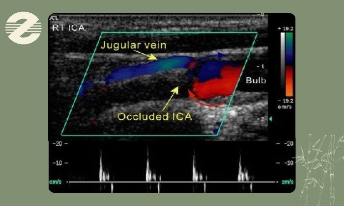 چه کسانی به سونوگرافی داپلر نیاز دارند؟