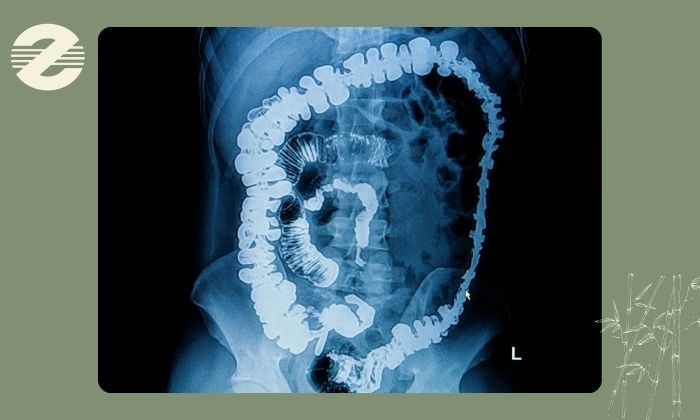 کاربرد تشخیصی باریم انما و کولونوسکوپی کاربرد تشخیصی باریم انما و کولونوسکوپی