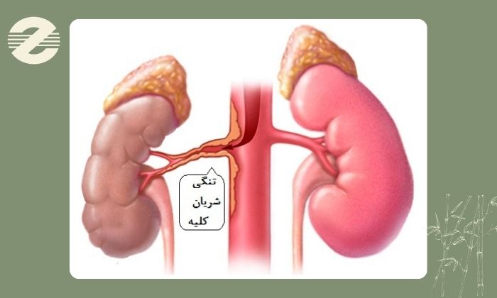 کاربردها و موارد تجویز سونوگرافی رنگی کلیه