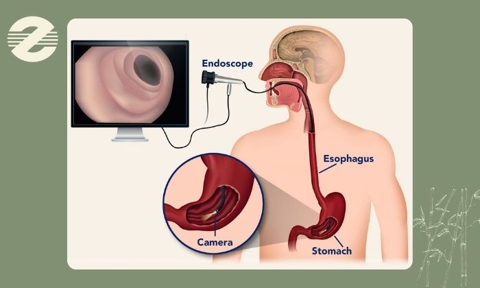 تفاوت‌های کلیدی باریم میل و گاستروسکوپی در تشخیص