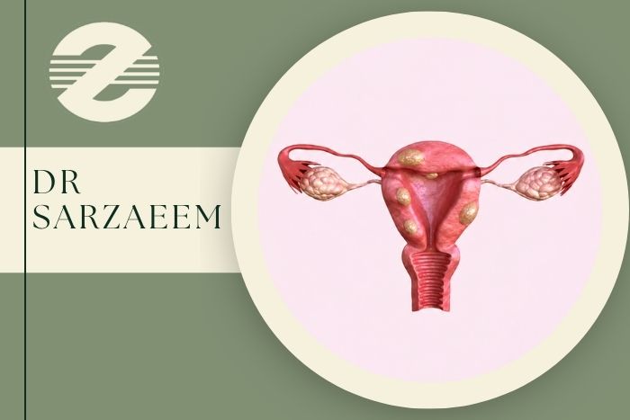چه فیبرومی نیاز به جراحی دارد و خطرناک است؟